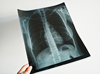 Биологи установили, что позволяет развиваться туберкулезу - «Новости Медицины»