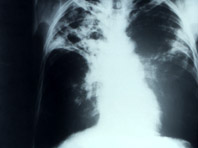 Эксперты рассказали, в каких странах выше риск заразиться стойким туберкулезом - «Новости Медицины»