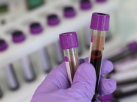 Каролинский институт доказал: обладатели первой группы крови реже страдают от рака - «Новости Медицины»