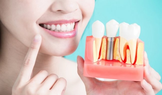 7 причин не откладывать имплантацию зубов - «Новости Медицины»