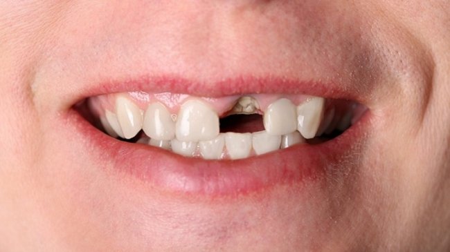 Вершки и корешки: можно ли спасти зуб, от которого остался только корень? - «Новости Медицины»