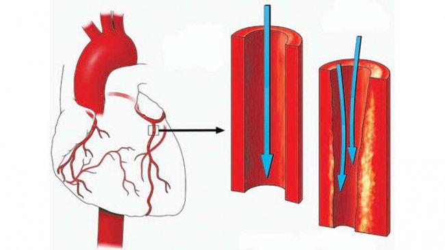 Все маски атеросклероза - «Новости Медицины»