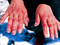 Повреждения, вызванные обморожением, возможно излечить, используя средство в форме спрея - «Новости Медицины»