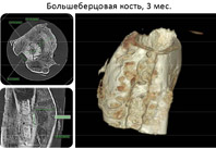 Российские ученые представили революционное средство для восстановления костей - «Новости Медицины»