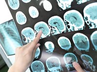 Неврологи смогли обратить развитие рассеянного склероза вспять - «Новости Медицины»