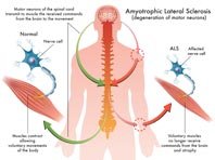 Новая терапия бокового амиотрофического склероза оказалась эффективной - «Новости Медицины»
