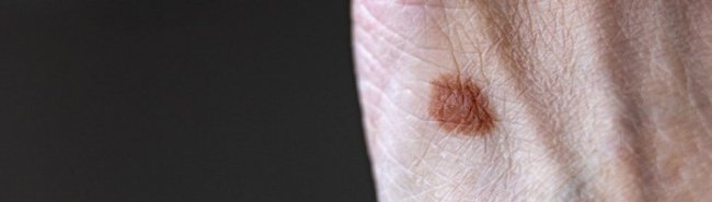 Эксцизионная биопсия диспластического невуса в условиях районной поликлиники – путь к раннему выявлению меланомы кожи - «Аллергология»