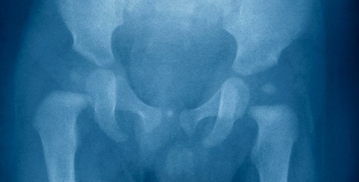 Болезни тазобедренного сустава у детей. Рентген тазобедренного сустава по Лаунштейну. Цементно костная дисплазия. Дисплазия плечевого сустава у детей.