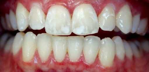 Почему на зубах появляются белые пятна и как их убрать - «Стоматология»