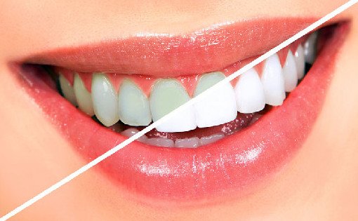 Чтобы улыбка сверкала, как в рекламе: как правильно чистить зубы? - «Стоматология»