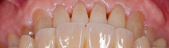 Тетрациклиновые зубы - «Гастроэнтерология»