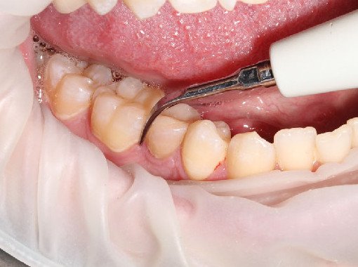 3 ошибки во время чистки зубов, которые портят вашу улыбку - «Стоматология»