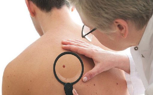 Рак кожи: что необходимо знать, чтобы не заболеть? - «Онкология»