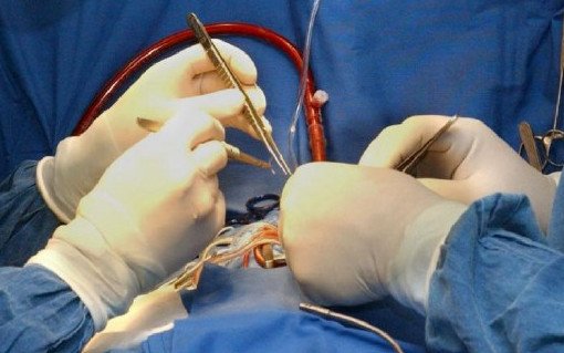 Операция на сердце приводит к ухудшению памяти и когнитивных процессов - «Хирургия»