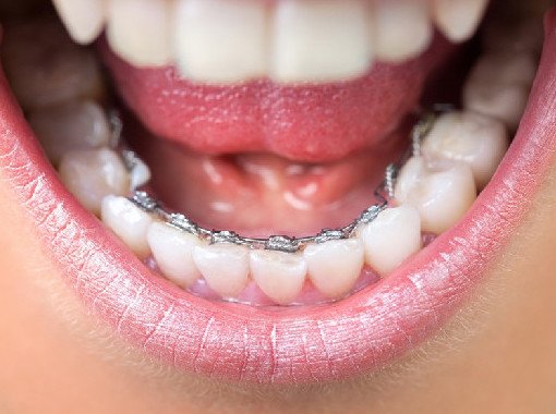 Качественные брекеты в стоматологии «Дента-Профессионал» - «Стоматология»