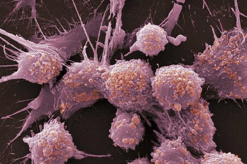 Ученые МФТИ выяснили, что раковая опухоль подчиняет себе соседние здоровые клетки - «Онкология»