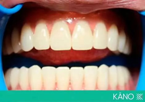 Базальная имплантация: лучшее решение для стабильной фиксации зубных протезов
