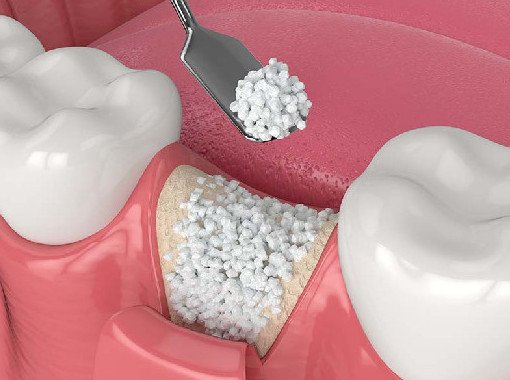 Импланты и не только. Что может разрушить кости челюсти? - «Стоматология»